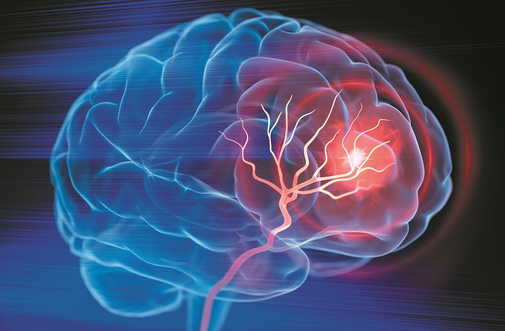 Stroke: New Treatments Mean New Hope | Bottom Line Inc