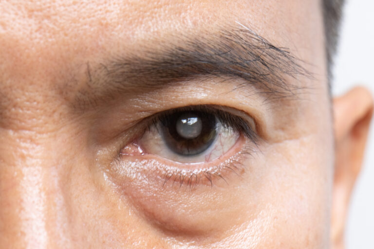 How Long Is Recovery From Cataract Surgery